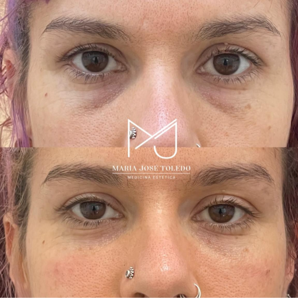 Relleno de ojeras