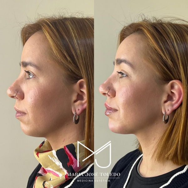 T-Profile