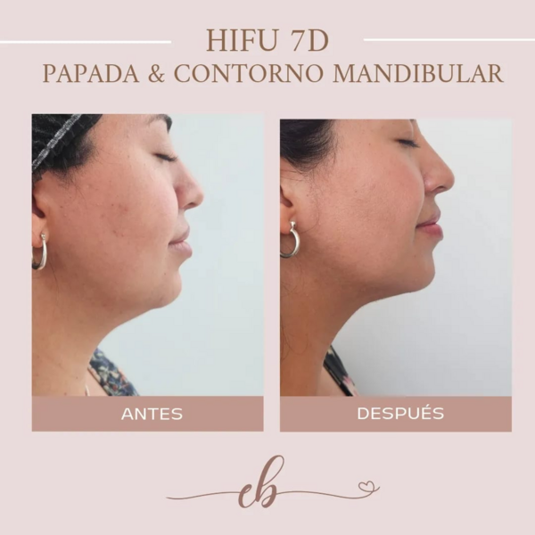 Hifu Papada (1 sesión)