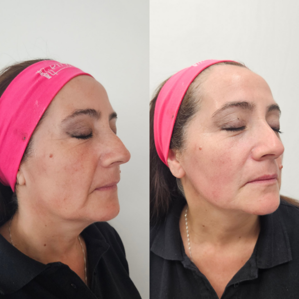Rostro completo, papada y cuello (HIFU 7D)