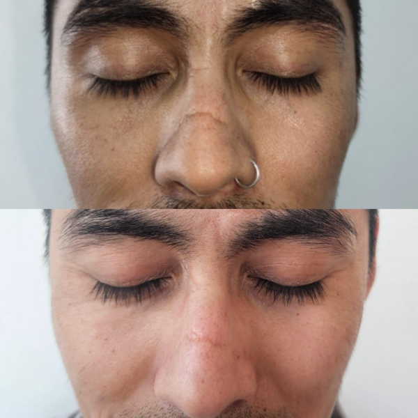 Tratamiento Plasma para cicatrices (1S)