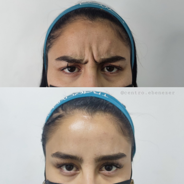 Promocion Toxina Botulinica (Botox) (3 zonas)
