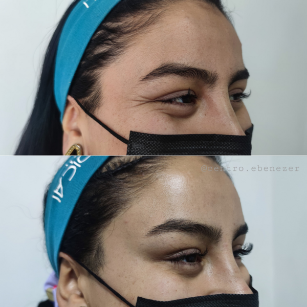 Promocion Toxina Botulinica (Botox) (3 zonas)
