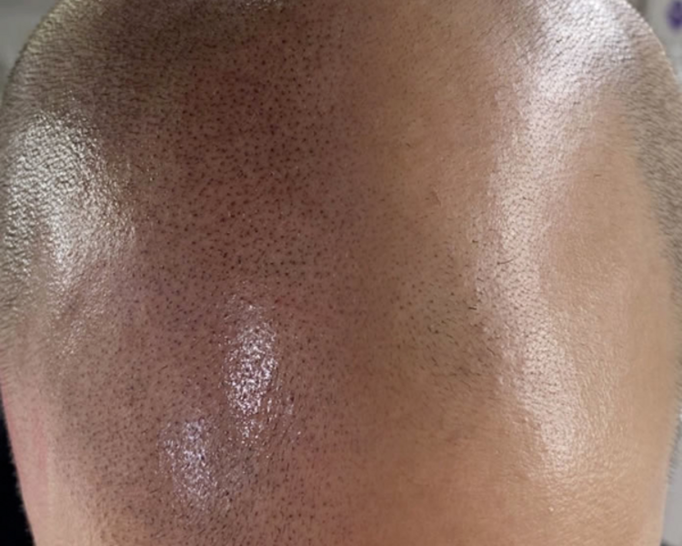 Micropigmentacón Técnica Scalp (alopecia) 