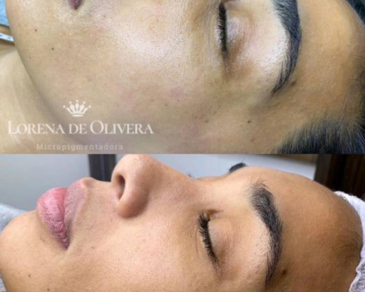 Limpieza de Cutis Profunda Con Extracción + Aparatologia 