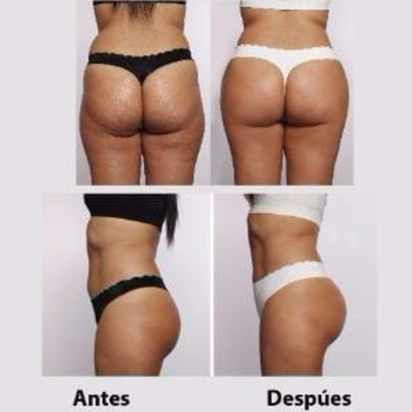 VACUMTERAPIA EN GLUTEOS