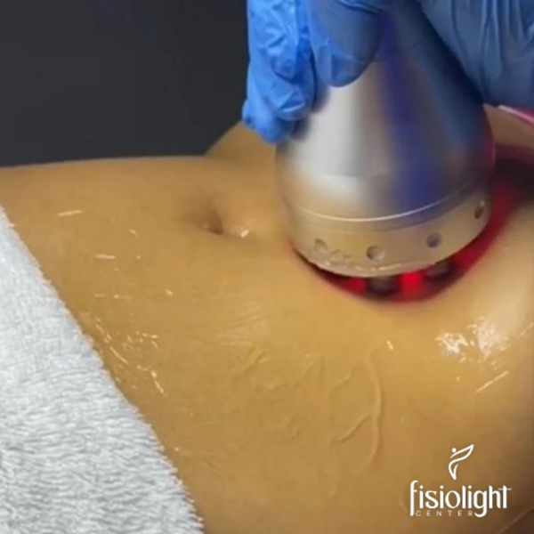 RADIOFRECUENCIA ABDOMEN