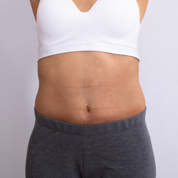 Hifu Abdomen