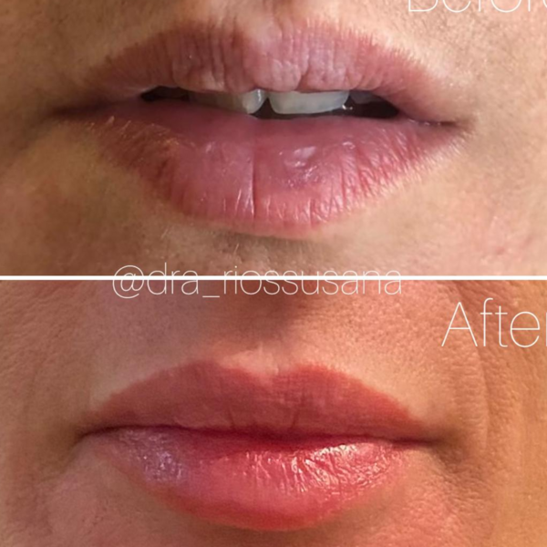 Relleno de labios con ácido hialurónico (JUVEDERM)
