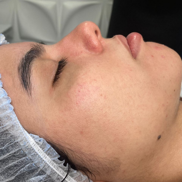 Dermaplaning