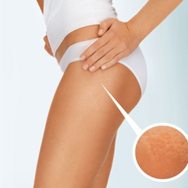 Tratamiento para (Celulitis  Flacidez y o Estrías) una sesión