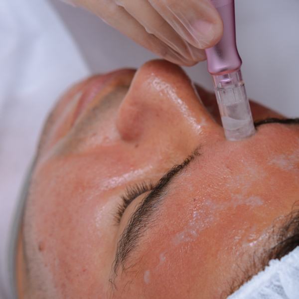 Micropunción (Dermapen)