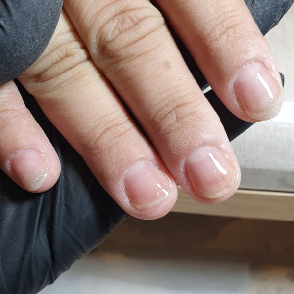 Tratamiento de Onicofagia