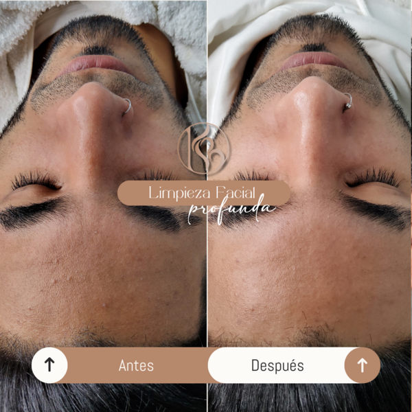 Limpieza facial profunda 