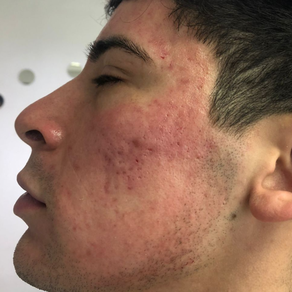 OFERTA DERMAPEN CON VITAMINA C 