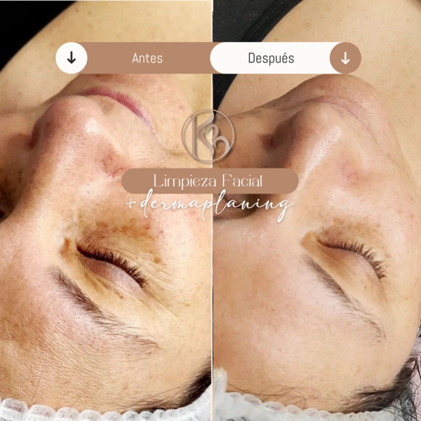 Limpieza facial profunda + Dermaplaning 