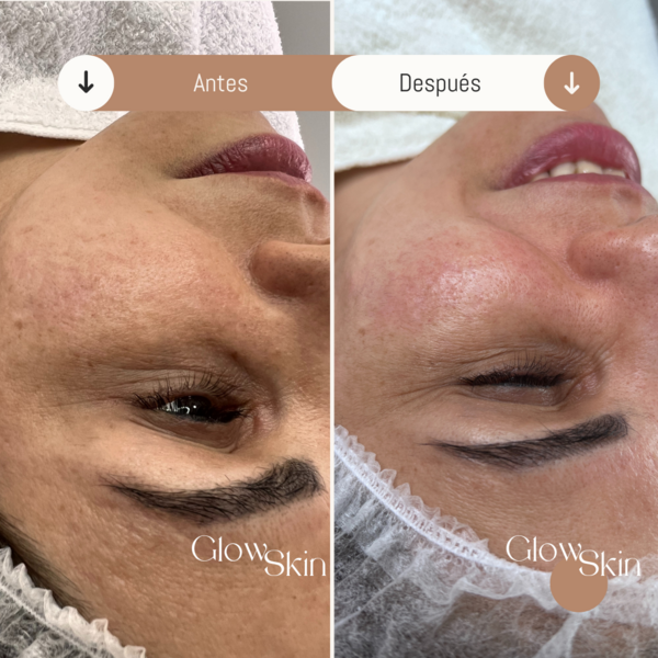 Limpieza facial profunda 