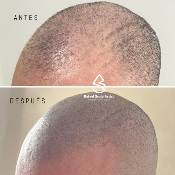 Scalp 3 sesiones 