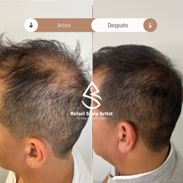 Scalp 3 sesiones 