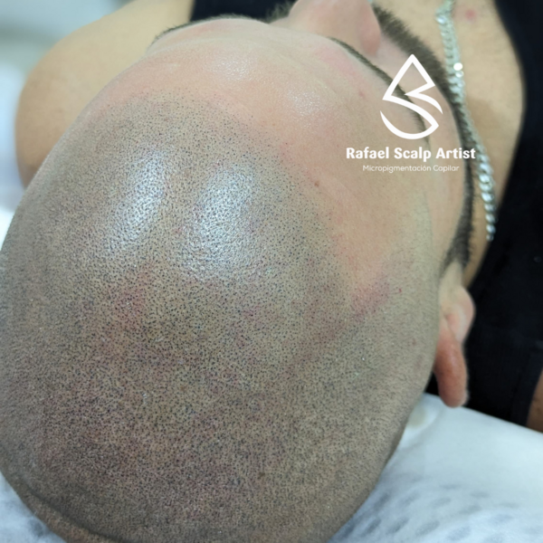 Scalp 3 sesiones 