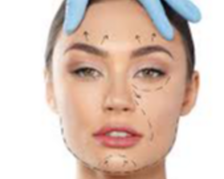 3 ml de Ácido Hialuronico 