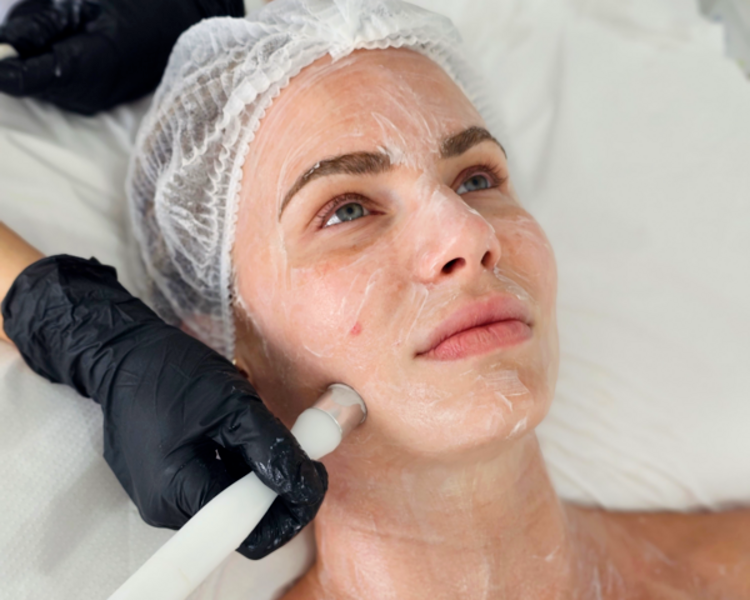 BABY FACE X 4 SESIONES (RADIOFRECUENCIA FACIAL)
