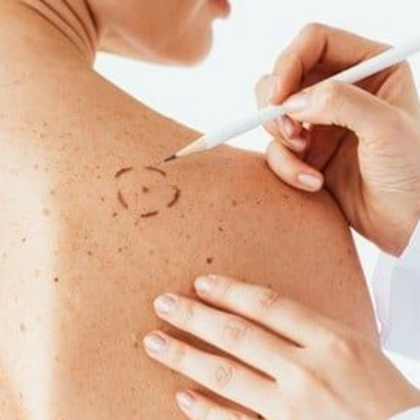 Remoción acrocordones-lunares