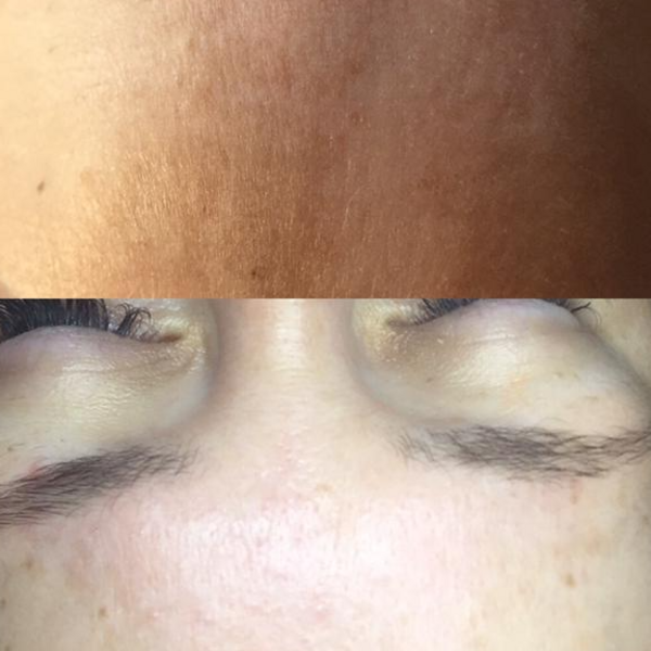 Dermaplaning más Higiene facial