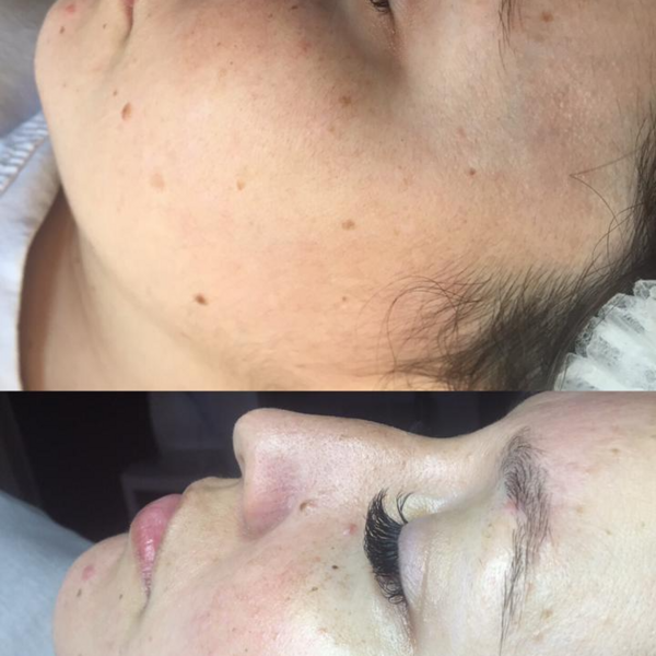 Dermaplaning más Higiene facial