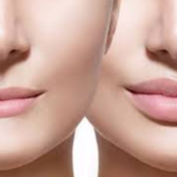 Bioplastía Labial ( Perfilado e labios y aumentó de volumen)