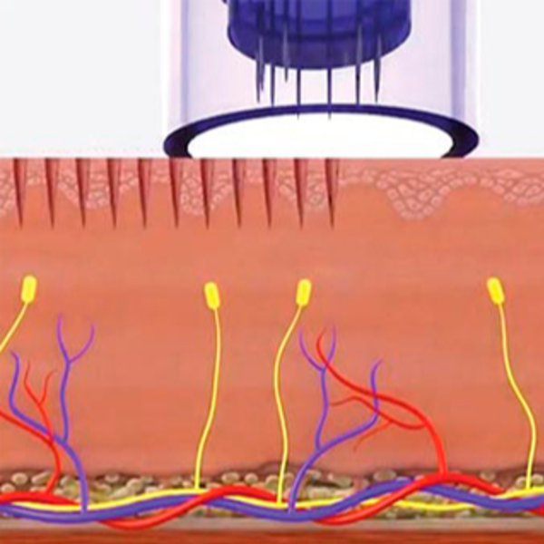 Microneedling Regenerativa "Derma Pen"