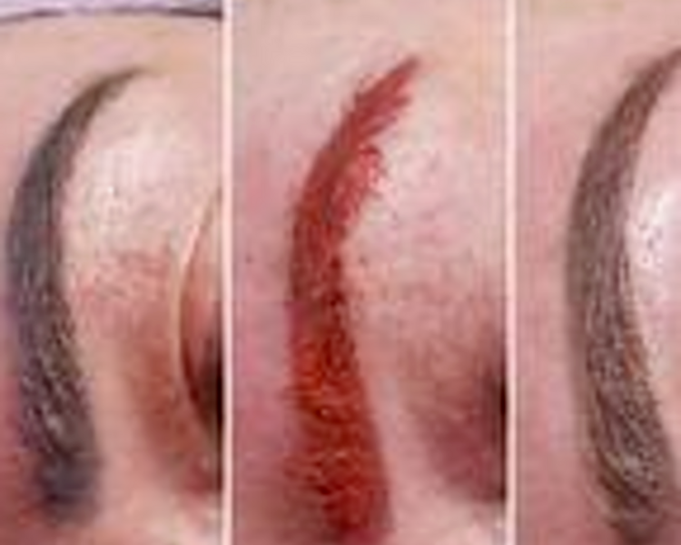 Neutralización de Cejas