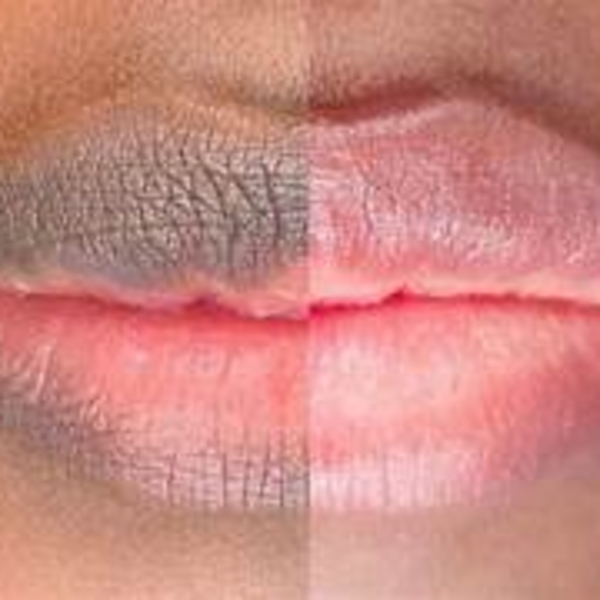 Aclaramiento labios oscuros 
