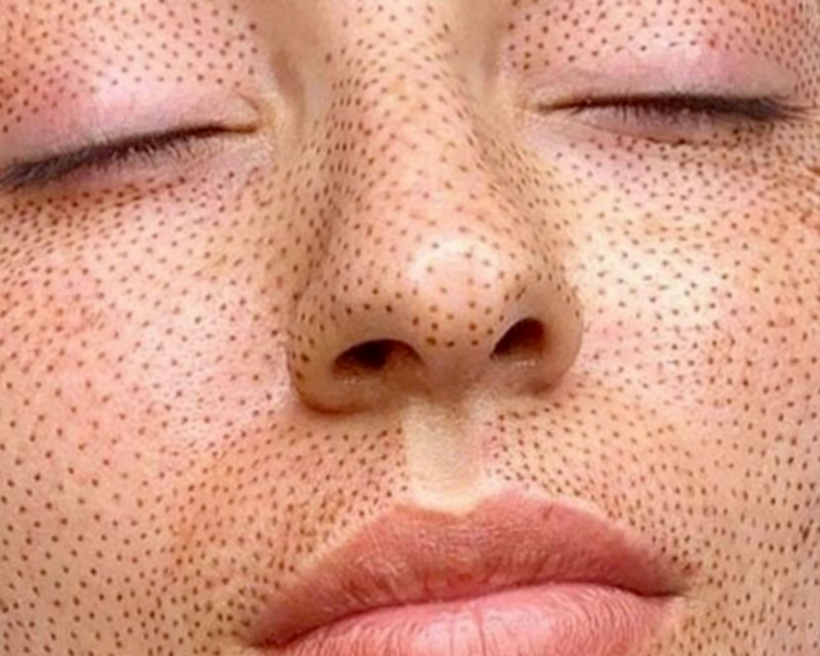 Plasma pen fibroblast