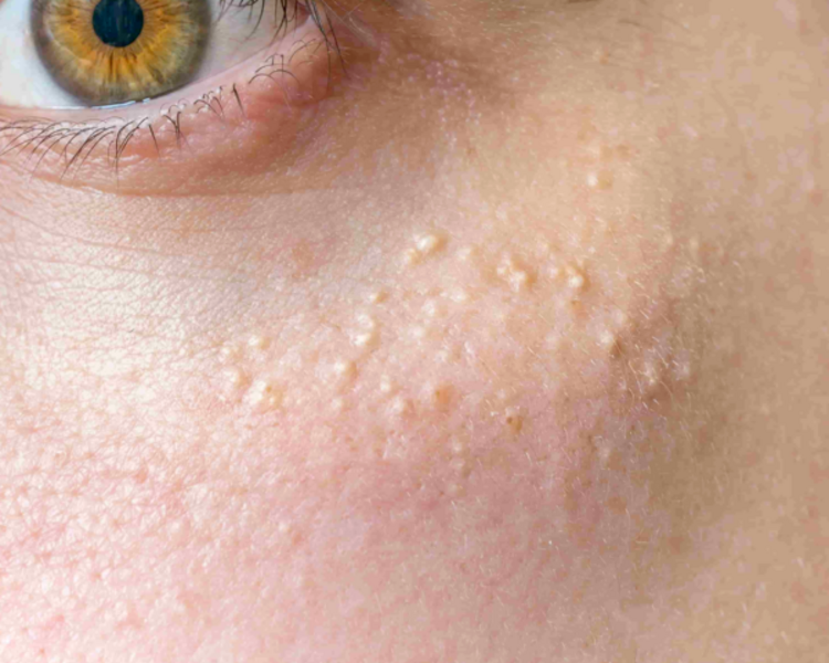 Limpieza profunda + Extracciones de Milliums