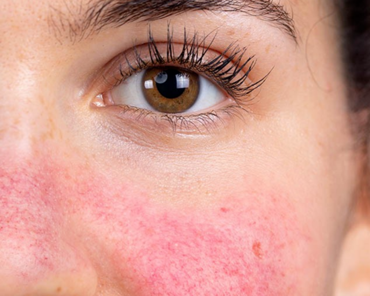 Tratamiento para rosácea