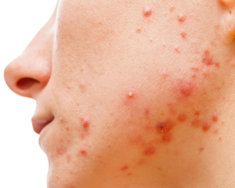 Tratamiento de acné