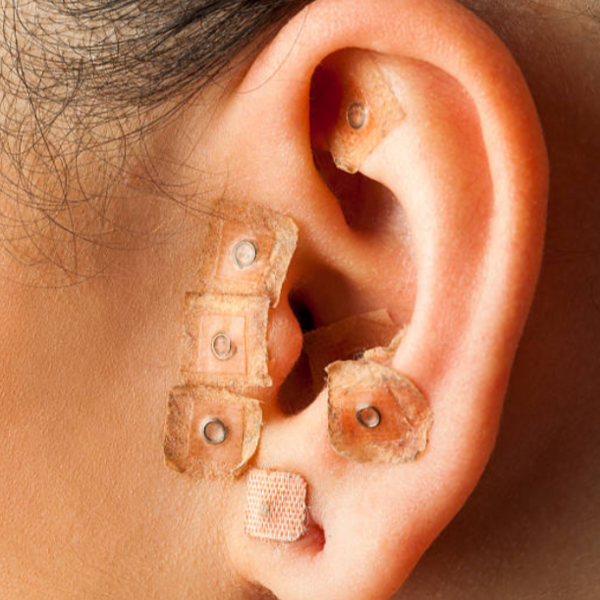 Auriculoterapia 