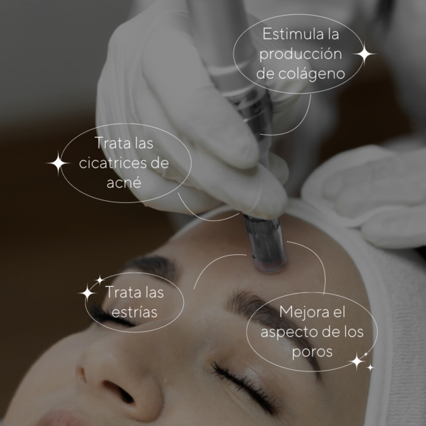 Microneedling 4 sesiones 