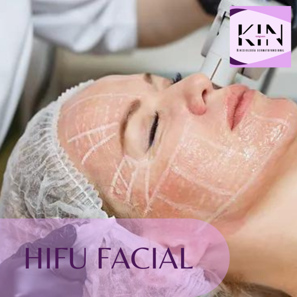 HIFU ROSTRO COMPLETO SIN PAPADA