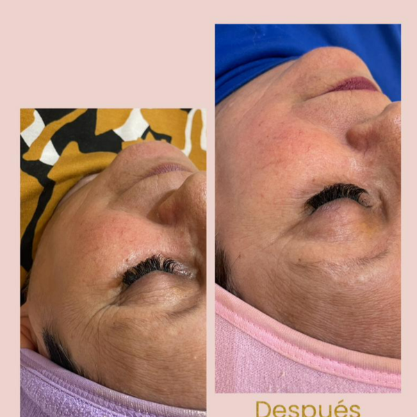 Peeling y plasma Facial