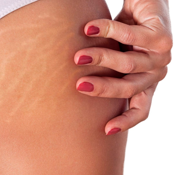 Estrías Bioestimulación (1 zona)