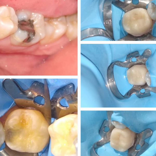 Resina dental / Composite Compuesta 