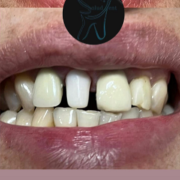 Corona Zirconio  