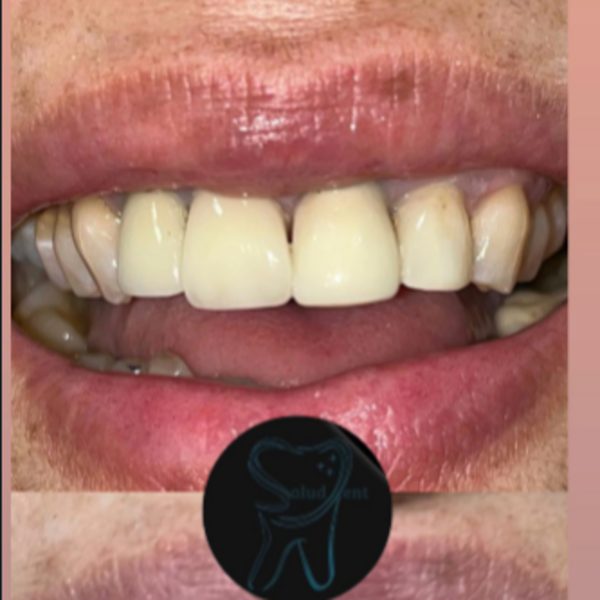Corona Zirconio  