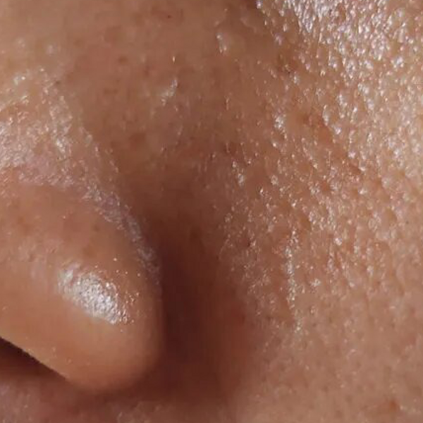 Peeling Azelaico Pieles grasas 