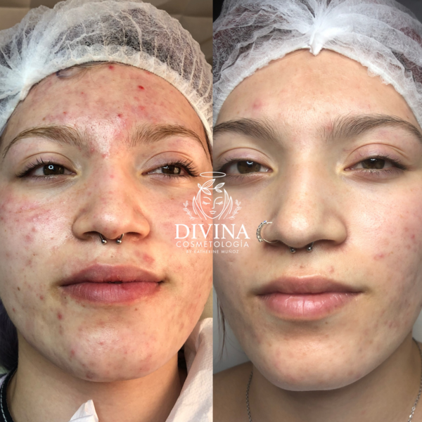 Dermapen 