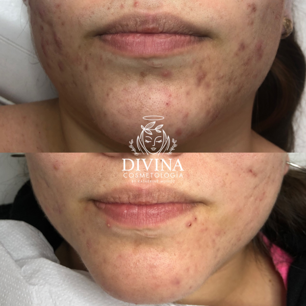 Dermapen 