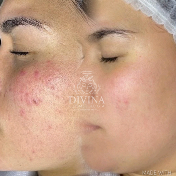 Dermapen 