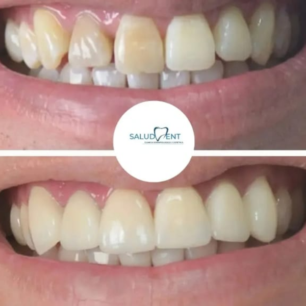 Blanqueamiento Dental